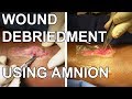Wound Debridement with an Application of an Amnion - Dr. Paul Ruff | West End Plastic Surgery