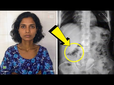 Sie Ging Zum Scan, Ärzte Fanden 1,5 Kg Metall In Ihrem Magen. Der Grund Ist Erschreckend!