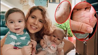 Hand, Foot & Mouth- What it looks like, how to cure it FAST!