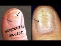 Do You Have These Horizontal Ridges On Your Nails?-Palmistry