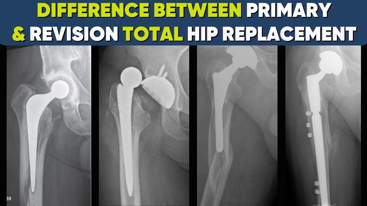 is REVISION Hip Replacement Surgery is SAME as PRIMARY THR?