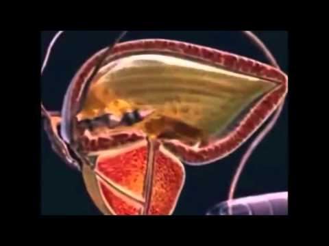 Prostata Strahlentherapie TRUS Prostata Fibrose