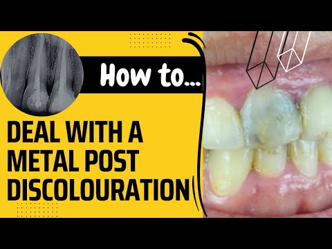 How To Deal With A Metal Post Discolouration