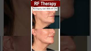 RF Therapy On Face Will Make You Tons Of Cash. Here&#39;s How!#RF_Therapy #face_glow #skinaaclinic#short