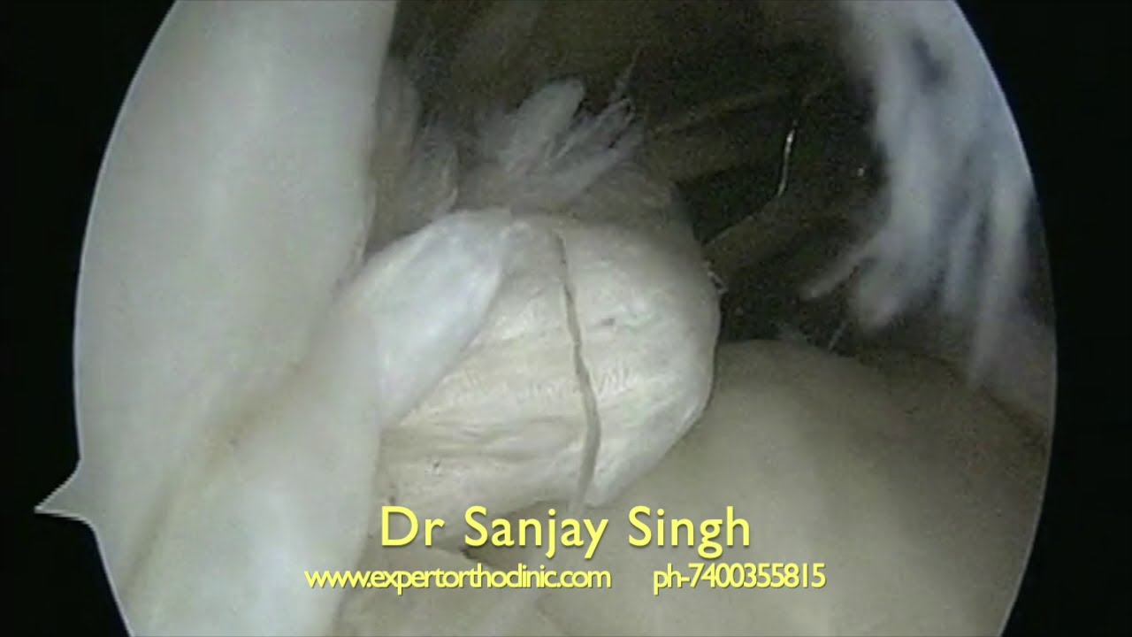 Arthroscopic Rotator Cuff Repair Surgery
