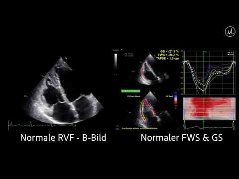 〖Echocardiografie〗Normaler Strain & normale RVF mit Fokus auf den rechten Ventrikel  📺🫀