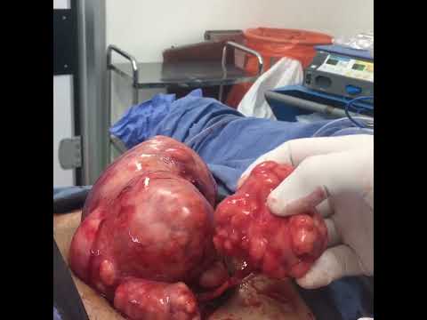 Tratamiento para miomatosis severa - Dr. Juan Federico Zapata ginecólogo medellín
