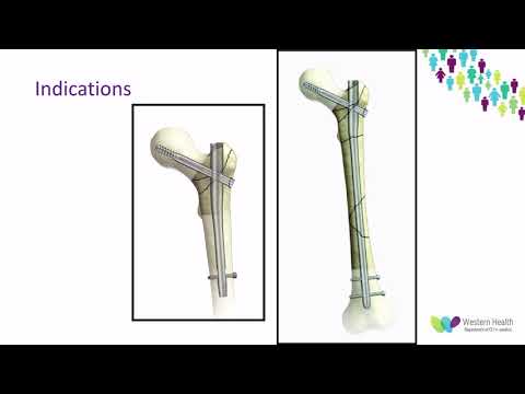 OrthoFracs Nail Length in Management of Intertrochanteric Femoral Fractures by Dr Adrian Talia