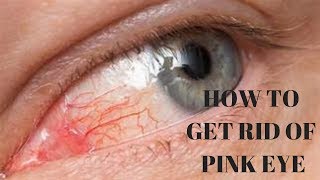 how to get rid of pink eye in 10 minutes