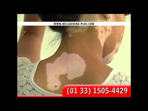 comment traiter vitiligo