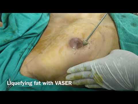 Patient Recovery Case — Video 42 (Body Sculpting)