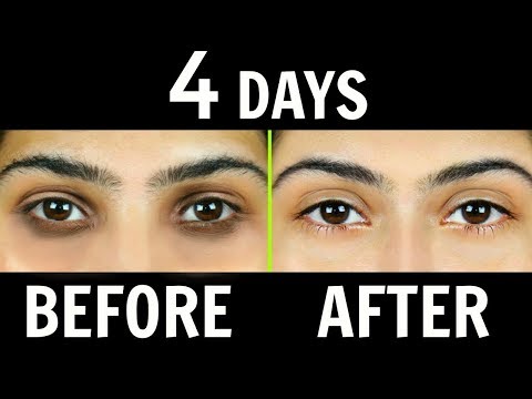 How to Remove Dark Circles Naturally in 4 Days (100% Results)