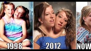 Interesting Things About Famous Conjoined Twins Abby And Brittany Hensel
