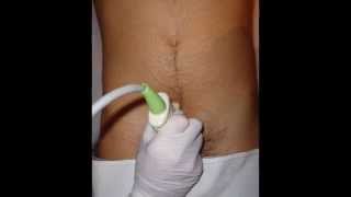 Vídeo 13  Estudio ecográfico de la próstata