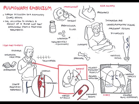 Embolia pulmonar: descripción general