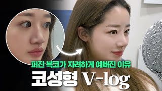 코 성형 자려하게 원하면 생기는 일 | 코성형 브이로그