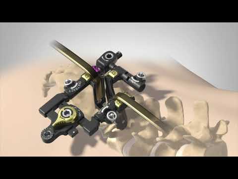 MAS TLIF animation (Japan)