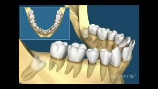 Emergency Dentist Upper East Side | Wisdom Tooth Extraction Upper East Side