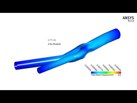 Fluid-Solid interaction simulation: Patient-specific Common Carotid Artery Bifurcation