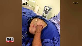Man Has Hand Sewn Into Stomach to Save Limb After Horrific Work Accident