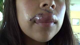 Facial Scar Revision Surgery Recovery Blog – Day 3, Lip is Still Swollen