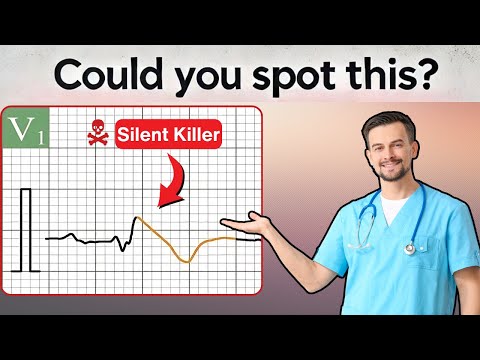 Brugada Syndrome: Why It's Called the "Silent Killer"