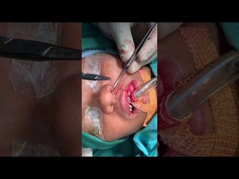Video On The Upper Lip Scar Revision