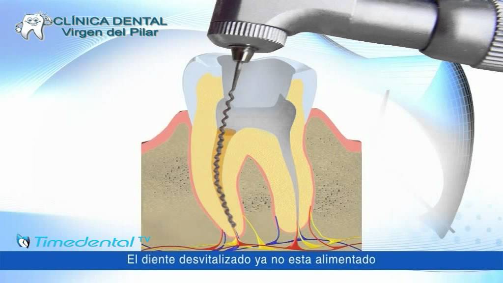 Watch Dolor de muelas y dientes, la corona, por Clínica Dental Virgen del Pilar Now Dolor de muelas y dientes, la corona, por Clínica Dental Virgen del Pilar