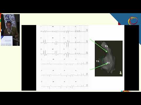 Interpretazione delle aritmie ventricolari nello sportivo giovane e nel senior - Prof. Luigi Sciarra
