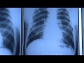 Dr.Jack Parker explains the three phases of Black Lung Disease