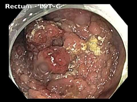 Grosse Lésion du Côlon - Vue Endoscopique