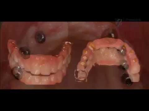 Zahnersatz mit Implantaten: Vorteile des synoptischen Behandlungskonzeptes