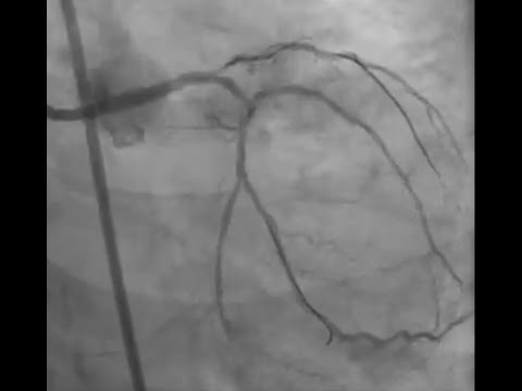 REVERSE TAP TECHNIQUE STENTING IN LM BIFURCATION