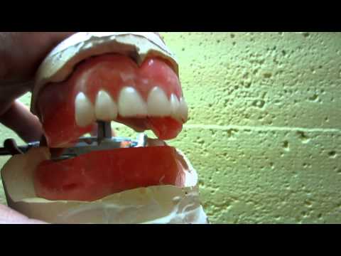 comment regler l'occlusion en prothese complete