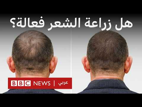 فيديو | كيف تتم زراعة الشعر وما هي أضرارها؟