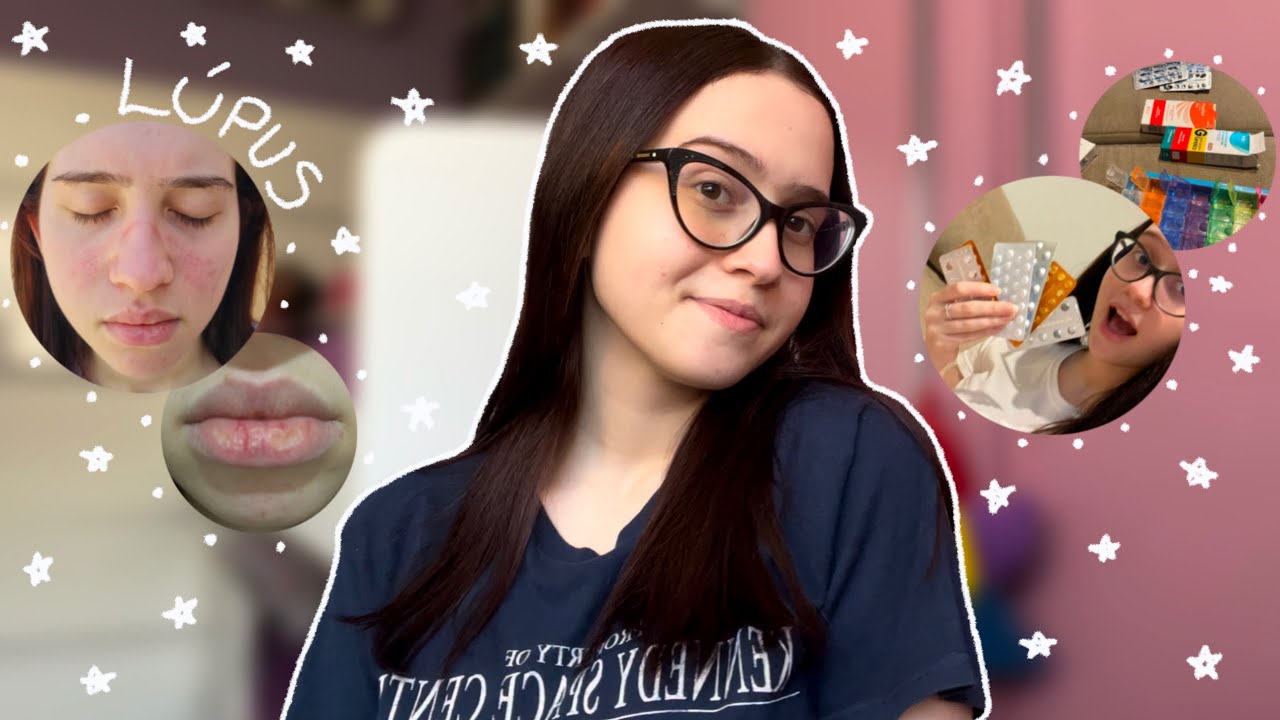 vivendo com doença autoimune - relato de alguém que tem lúpus e behçet