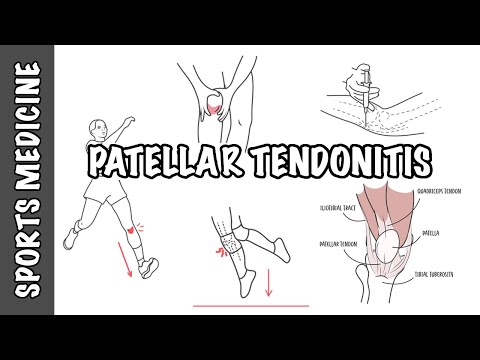 Tendinite Rotulienne et Tendinopathie Rotulienne