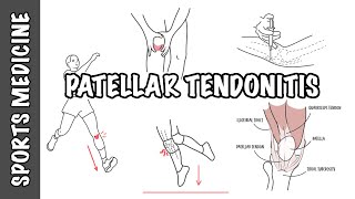 Patellar Tendonitis and Patellar Tendinopathy