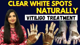 How to treat Vitiligo naturally | What Causes White Spots| How to Clear White Spots on the Skin