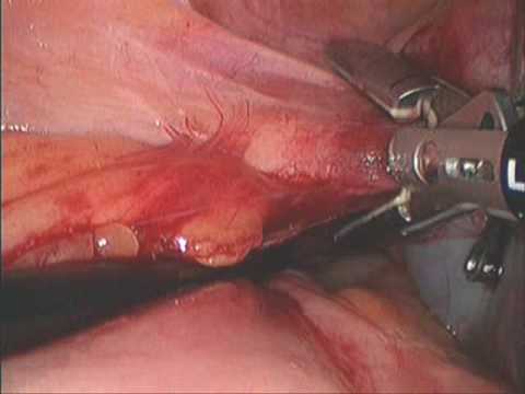 SELS: Laparoscopic Oophorectomy with Decompression