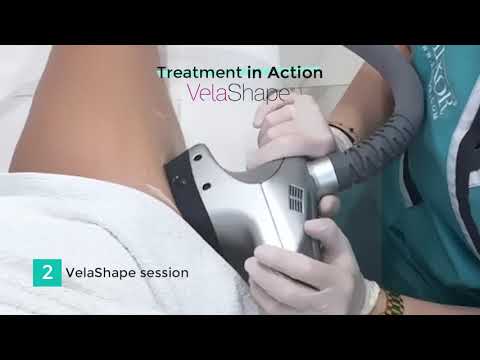 VELASHAPE TREATMENT 