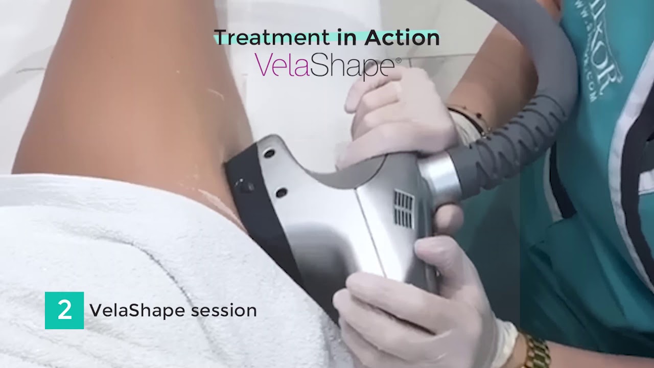 VELASHAPE TREATMENT 