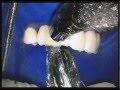 Bioclear - Black Triangle