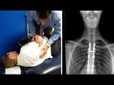Dr. Jason - CHIROPRACTIC CARE With POST-SURGICAL FUSION