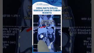 Viral Video Batu Ginjal Sebesar Jahe di Tubuh Wanita, Salah Satu Penyebab Gara-gara Malas ke Toilet