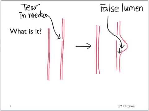 Aortic Dissection - Part 1