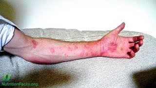 Tick Bites, Meat Allergies, and Chronic Urticaria