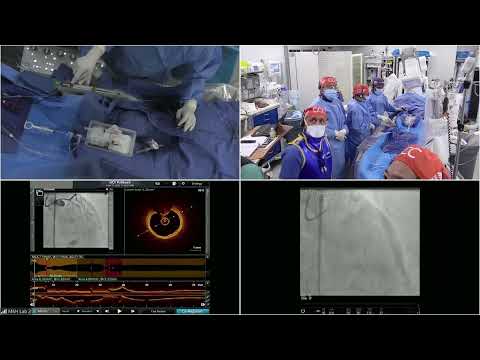 LIVE CASE 4 - OCT Guided PCI of Calcified LAD/D1 Bifurcation using OAS and Mini-Crush Technique