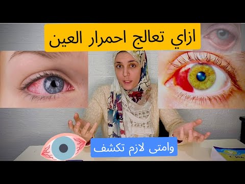 احمرار العين | علاج احمرار العين طبيعيا في المنزل وامتى تزور الطبيب #جفاف_العين