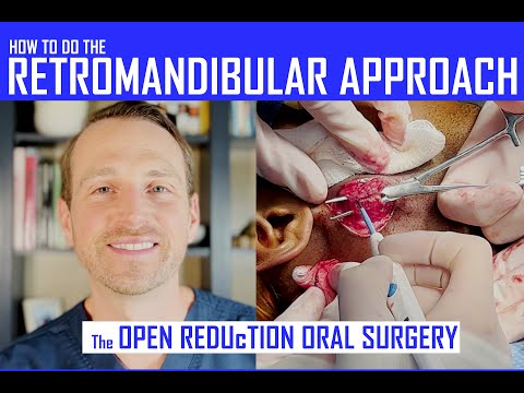 How To Do The Retromandibular Approach & Dissection